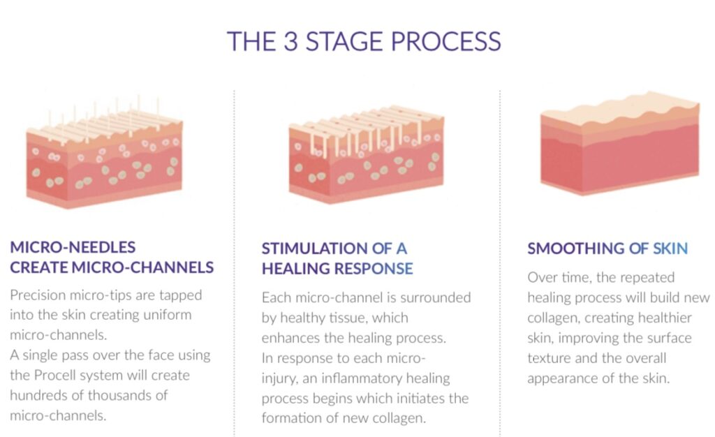 Progression of results after Microneedling