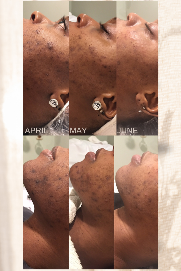 Before and After Acne treatment in Falmouth Maine