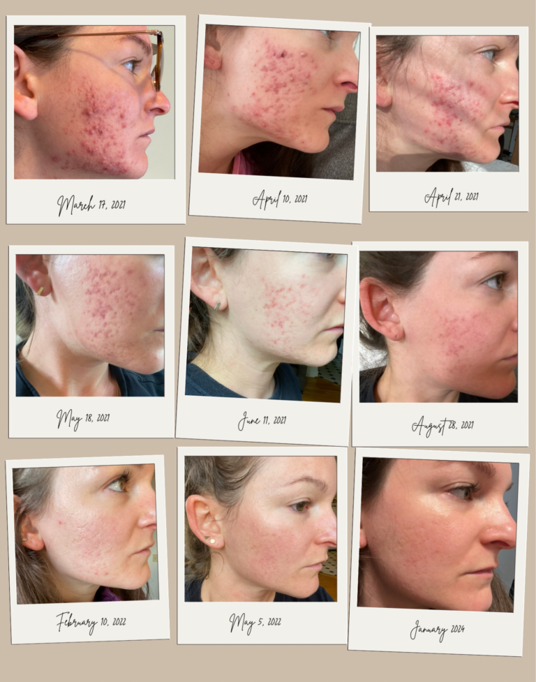 Before and After Acne treatment at Mint Salon Block